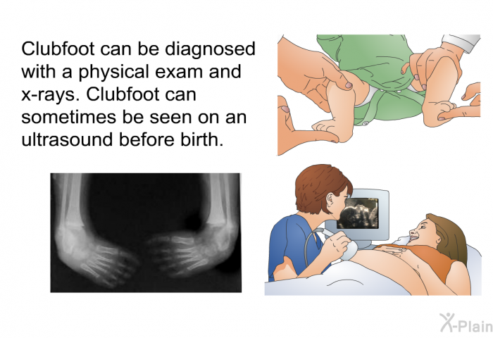 Clubfoot can be diagnosed with a physical exam and x-rays. Clubfoot can sometimes be seen on an ultrasound before birth.