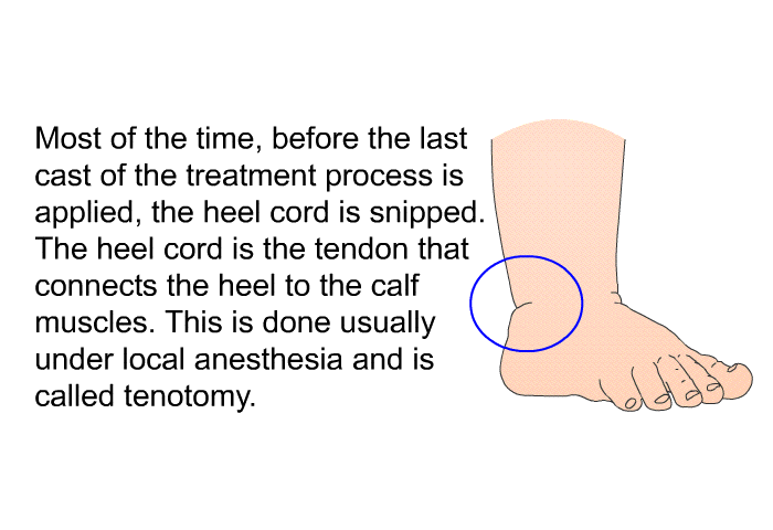 Most of the time, before the last cast of the treatment process is applied, the heel cord is snipped. The heel cord is the tendon that connects the heel to the calf muscles. This is done usually under local anesthesia and is called tenotomy.