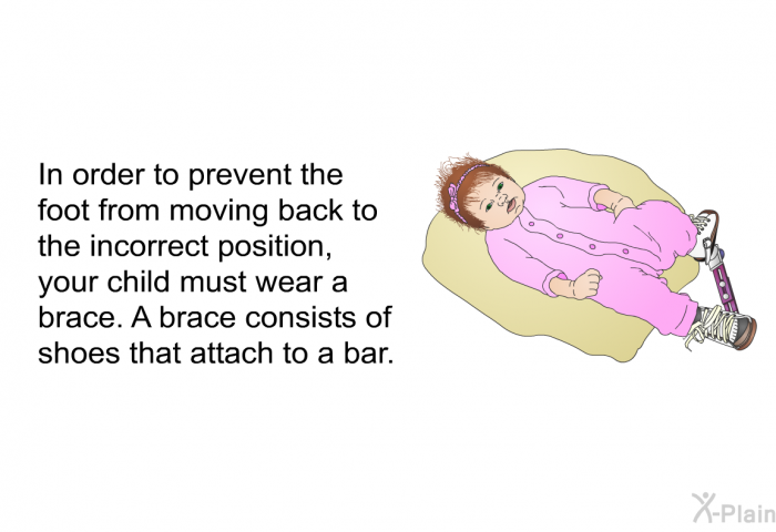 In order to prevent the foot from moving back to the incorrect position, your child must wear a brace. A brace consists of shoes that attach to a bar.