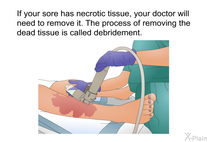 If your sore has necrotic tissue, your doctor will need to remove it. The process of removing the dead tissue is called debridement.