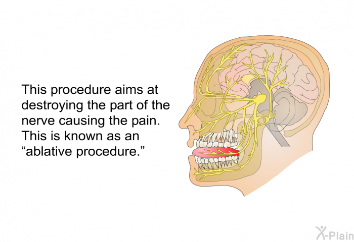 This procedure aims at destroying the part of the nerve causing the pain. This is known as an “ablative procedure.”