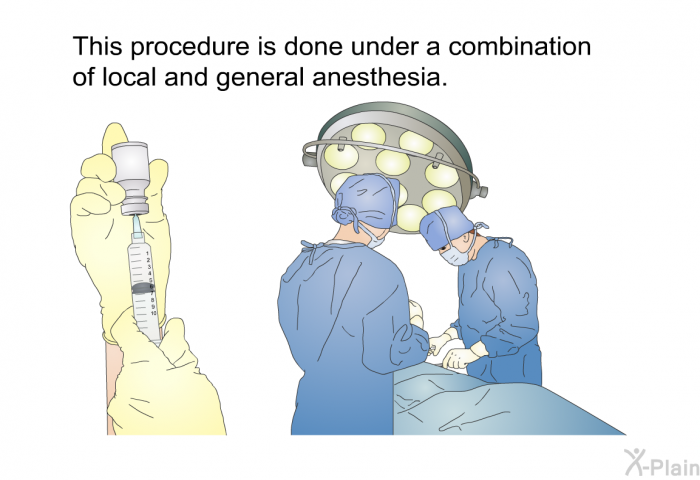 This procedure is done under a combination of local and general anesthesia.