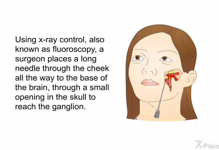 Using x-ray control, also known as fluoroscopy, a surgeon places a long needle through the cheek all the way to the base of the brain, through a small opening in the skull to reach the ganglion.