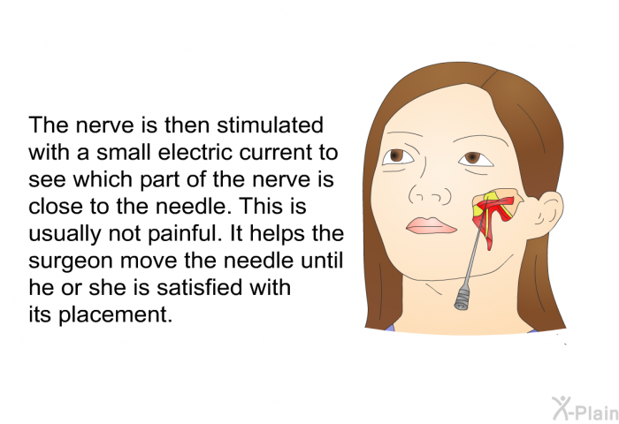 The nerve is then stimulated with a small electric current to see which part of the nerve is close to the needle. This is usually not painful. It helps the surgeon move the needle until he or she is satisfied with its placement.