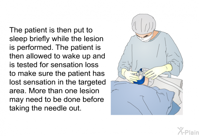 The patient is then put to sleep briefly while the lesion is performed. The patient is then allowed to wake up and is tested for sensation loss to make sure the patient has lost sensation in the targeted area. More than one lesion may need to be done before taking the needle out.