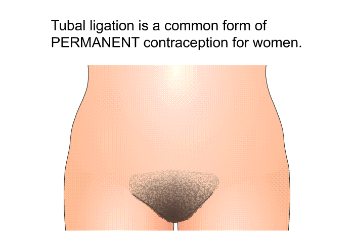 Tubal ligation is a common form of PERMANENT contraception for women.
