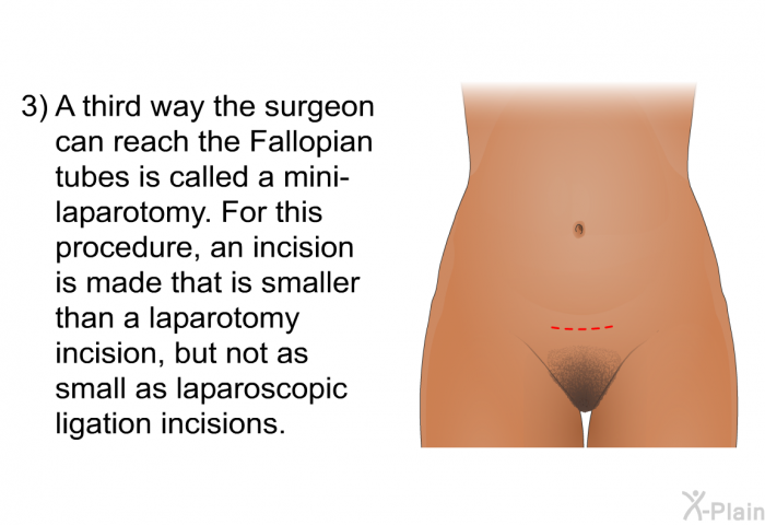 A third way the surgeon can reach the Fallopian tubes is called a mini-laparotomy. For this procedure, an incision is made that is smaller than a laparotomy incision, but not as small as laparoscopic ligation incisions.