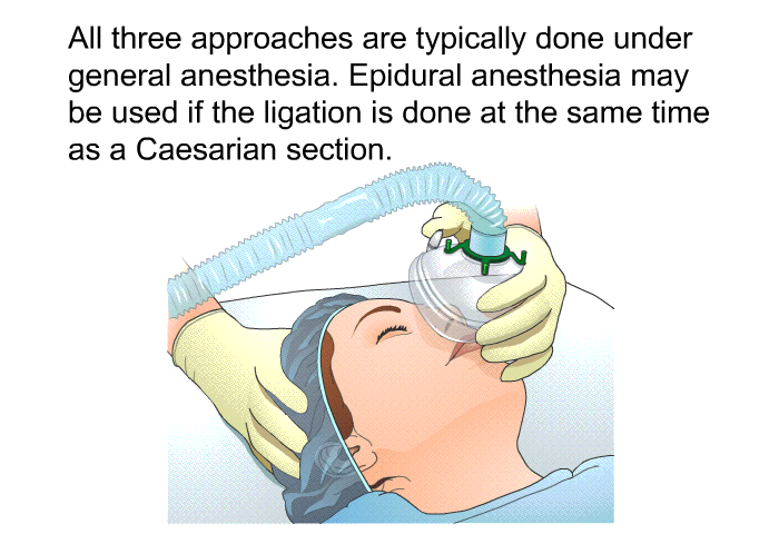 All three approaches are typically done under general anesthesia. Epidural anesthesia may be used if the ligation is done at the same time as a Caesarian section.
