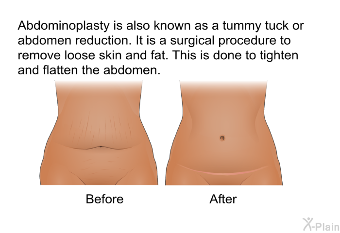 Abdominoplasty is also known as a tummy tuck or abdomen reduction. It is a surgical procedure to remove loose skin and fat. This is done to tighten and flatten the abdomen.