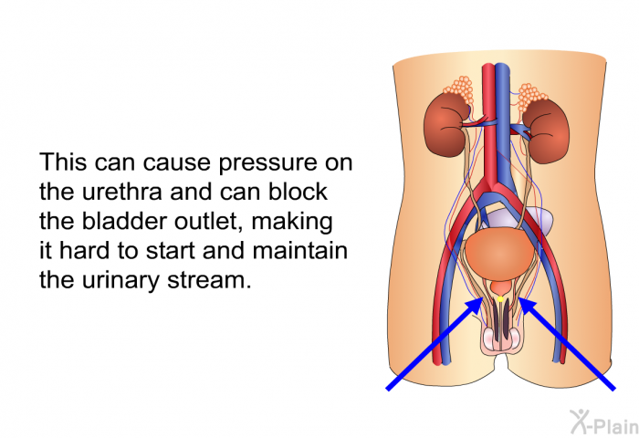 This can cause pressure on the urethra and can block the bladder outlet, making it hard to start and maintain the urinary stream.
