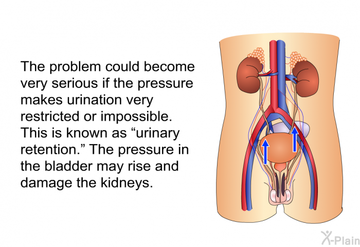 The problem could become very serious if the pressure makes urination very restricted or impossible. This is known as “urinary retention.” The pressure in the bladder may rise and damage the kidneys.
