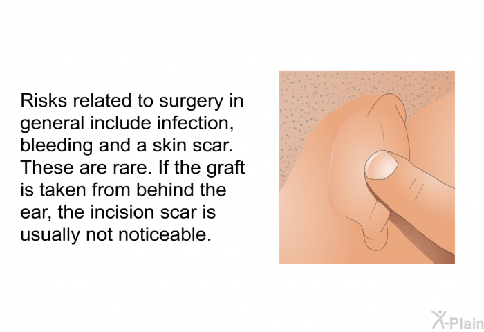 Risks related to surgery in general include infection, bleeding and a skin scar. These are rare. If the graft is taken from behind the ear, the incision scar is usually not noticeable.