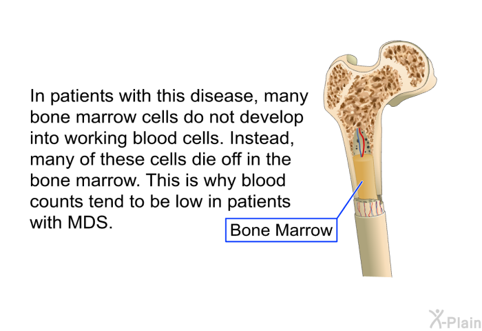 In patients with this disease, many bone marrow cells do not develop into working blood cells. Instead, many of these cells die off in the bone marrow. This is why blood counts tend to be low in patients with MDS.