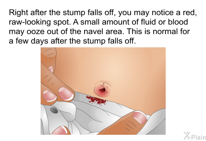 Right after the stump falls off, you may notice a red, raw-looking spot. A small amount of fluid or blood may ooze out of the navel area. This is normal for a few days after the stump falls off.