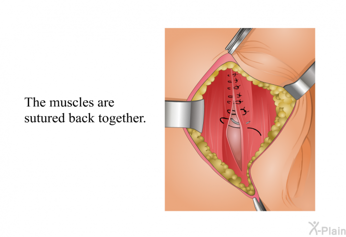 The muscles are sutured back together.