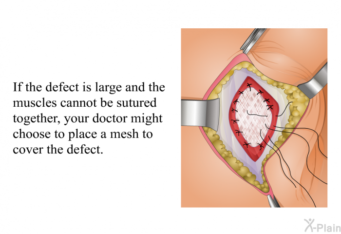 If the defect is large and the muscles cannot be sutured together, your doctor might choose to place a mesh to cover the defect.