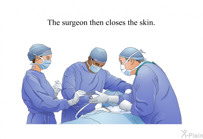 The surgeon then closes the skin.