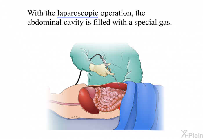 With the laparoscopic operation, the abdominal cavity is filled with a special gas.