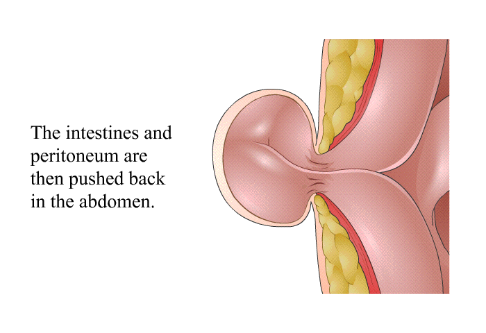 The intestines and peritoneum are then pushed back in the abdomen.