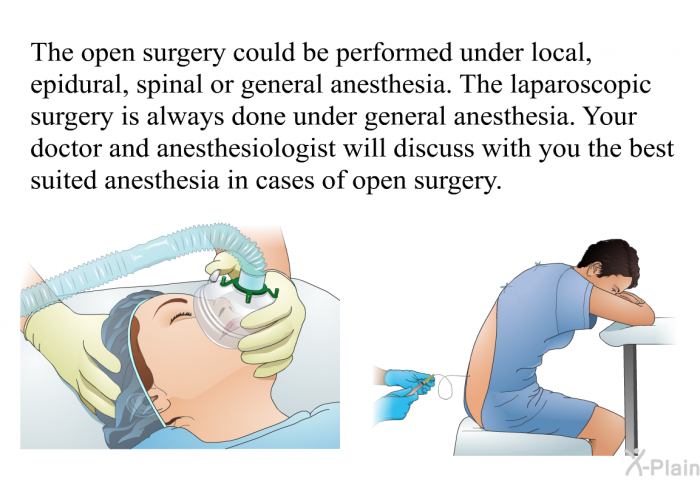 The open surgery could be performed under local, epidural, spinal or general anesthesia. The laparoscopic surgery is always done under general anesthesia. Your doctor and anesthesiologist will discuss with you the best suited anesthesia in cases of open surgery.