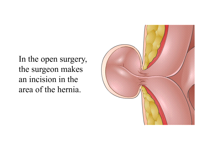 In the open surgery, the surgeon makes an incision in the area of the hernia.