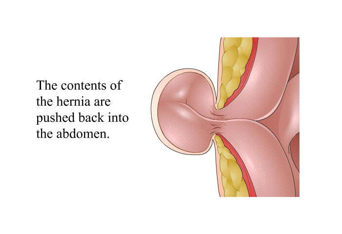 The contents of the hernia are pushed back into the abdomen.