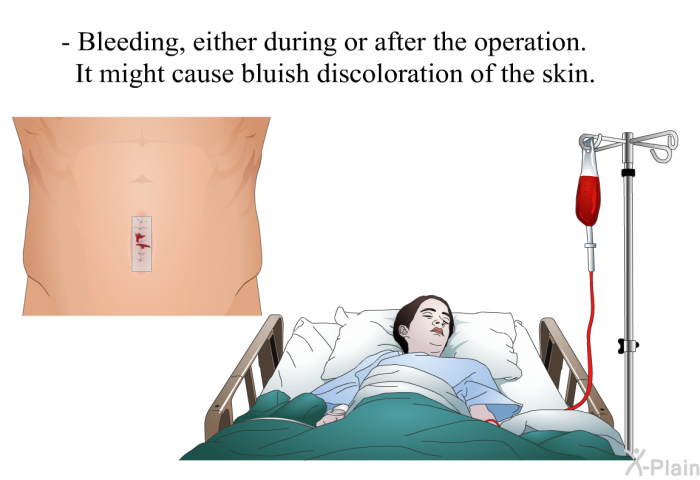 Bleeding, either during or after the operation. It might cause bluish discoloration of the skin.