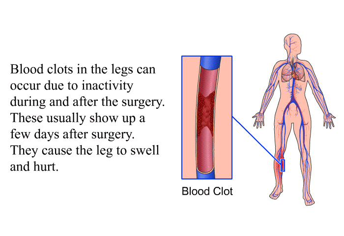 Blood clots in the legs can occur due to inactivity during and after the surgery. These usually show up a few days after surgery. They cause the leg to swell and hurt.