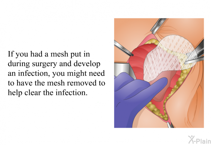 If you had a mesh put in during surgery and develop an infection, you might need to have the mesh removed to help clear the infection.
