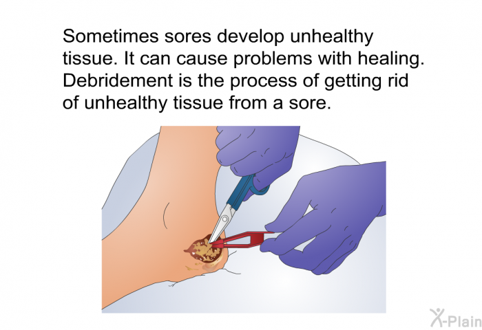 Sometimes sores develop unhealthy tissue. It can cause problems with healing. Debridement is the process of getting rid of unhealthy tissue from a sore.