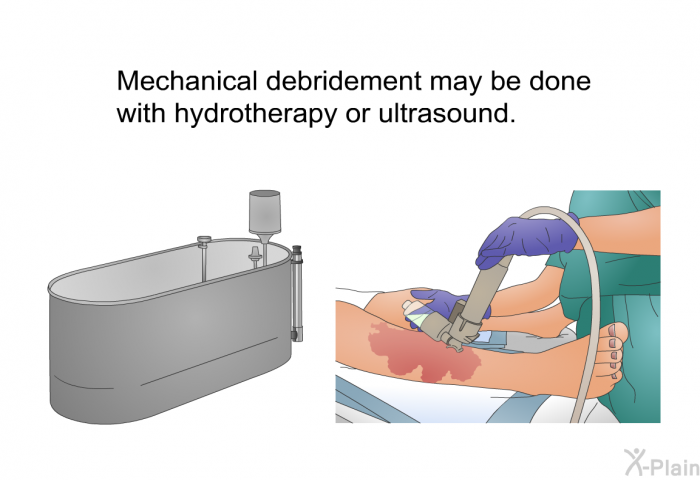 Mechanical debridement may be done with hydrotherapy or ultrasound.