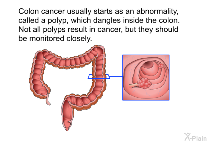 Colon cancer usually starts as an abnormality, called a polyp, which dangles inside the colon. Not all polyps result in cancer, but they should be monitored closely.