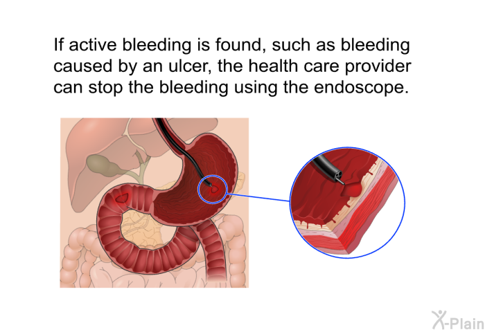 If active bleeding is found, such as bleeding caused by an ulcer, the health care provider can stop the bleeding using the endoscope.