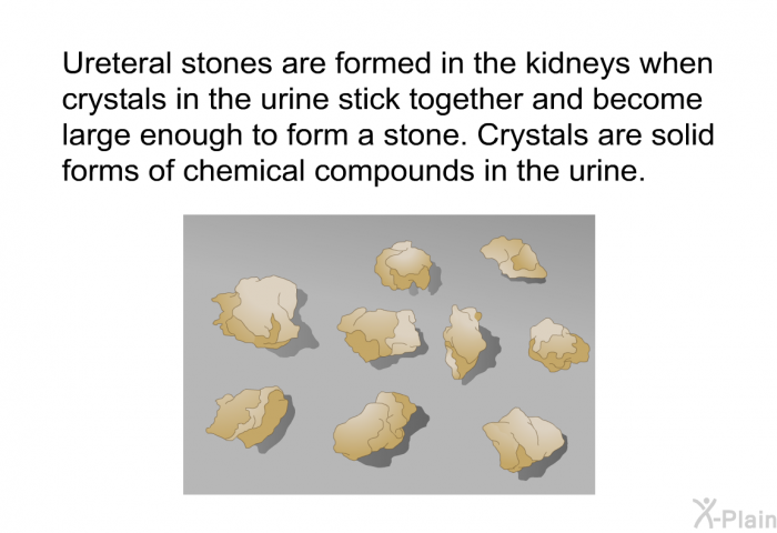 Ureteral stones are formed in the kidneys when crystals in the urine stick together and become large enough to form a stone. Crystals are solid forms of chemical compounds in the urine.
