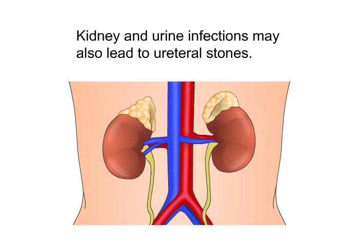 Kidney and urine infections may also lead to ureteral stones.