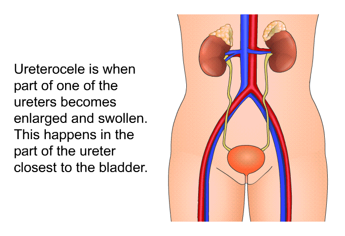Ureterocele is when part of one of the ureters becomes enlarged and swollen. This happens in the part of the ureter closest to the bladder.