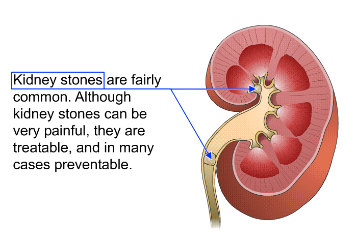 Kidney stones are fairly common. Although kidney stones can be very painful, they are treatable, and in many cases preventable.