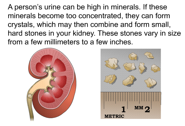 A person's urine can be high in minerals. If these minerals become too concentrated, they can form crystals, which may then combine and form small, hard stones in your kidney. These stones vary in size from a few millimeters to a few inches.