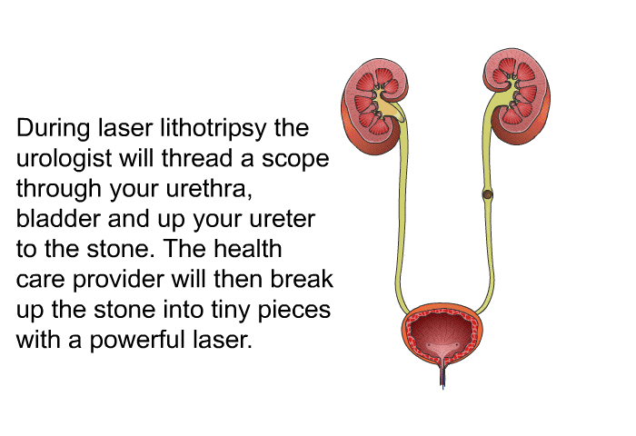During laser lithotripsy the urologist will thread a scope through your urethra, bladder and up your ureter to the stone. The health care provider will then break up the stone into tiny pieces with a powerful laser.