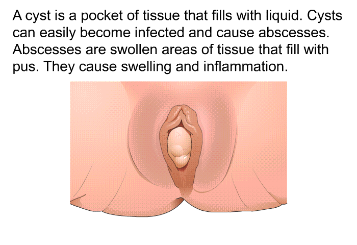 A cyst is a pocket of tissue that fills with liquid. Cysts can easily become infected and cause abscesses. Abscesses are swollen areas of tissue that fill with pus. They cause swelling and inflammation.