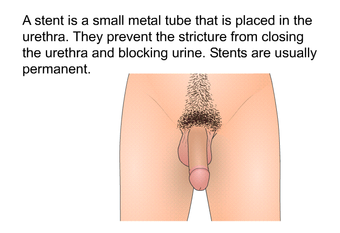 A stent is a small metal tube that is placed in the urethra. They prevent the stricture from closing the urethra and blocking urine. Stents are usually permanent.