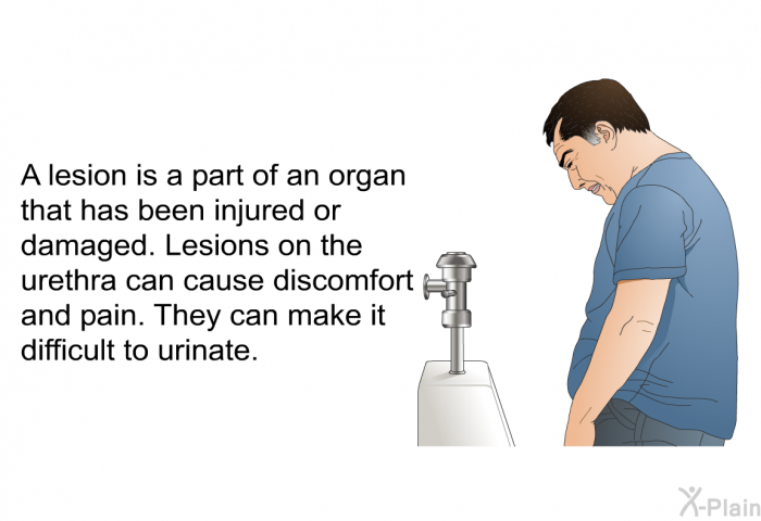 A lesion is a part of an organ that has been injured or damaged. Lesions on the urethra can cause discomfort and pain. They can make it difficult to urinate.