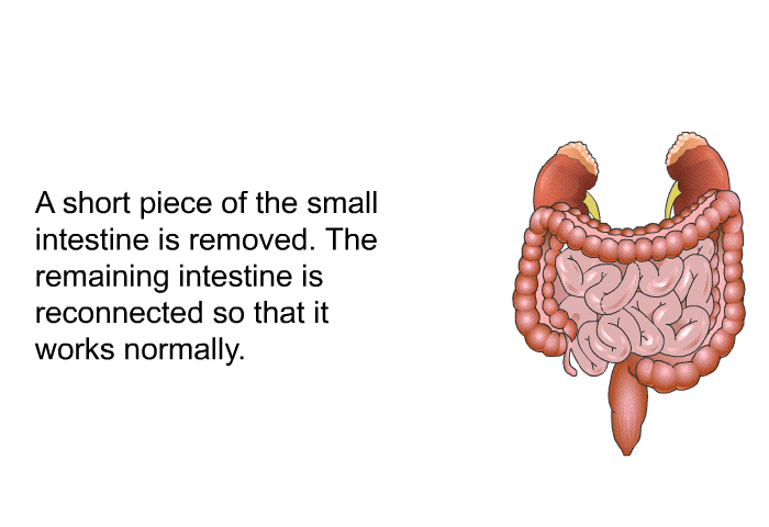 A short piece of the small intestine is removed. The remaining intestine is reconnected so that it works normally.