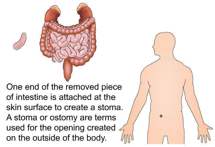 One end of the removed piece of intestine is attached at the skin surface to create a stoma. A stoma or ostomy are terms used for the opening created on the outside of the body.