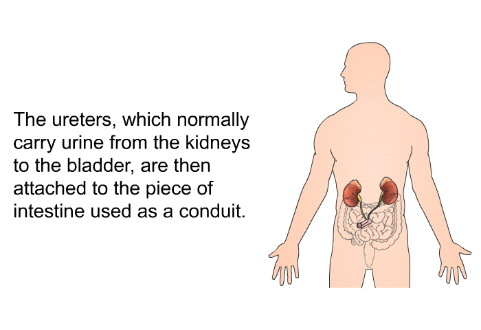 The ureters, which normally carry urine from the kidneys to the bladder, are then attached to the piece of intestine used as a conduit.