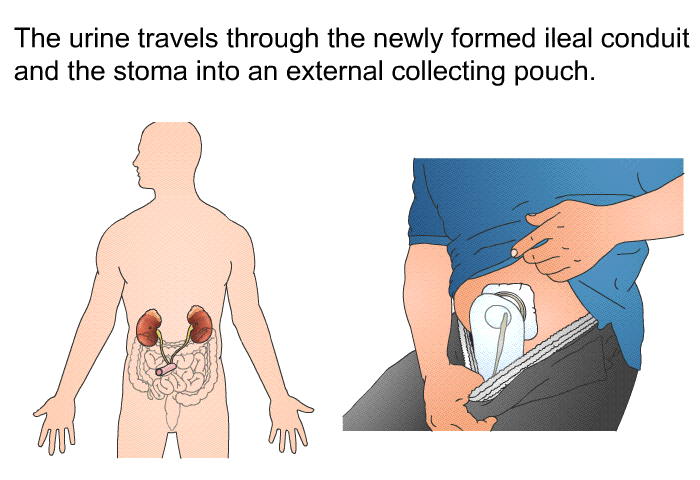 The urine travels through the newly formed ileal conduit and the stoma into an external collecting pouch.