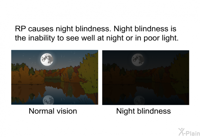 RP causes night blindness. Night blindness is the inability to see well at night or in poor light.