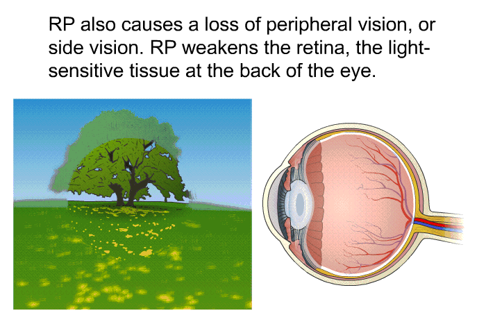 RP also causes a loss of peripheral vision, or side vision. RP weakens the retina, the light-sensitive tissue at the back of the eye.