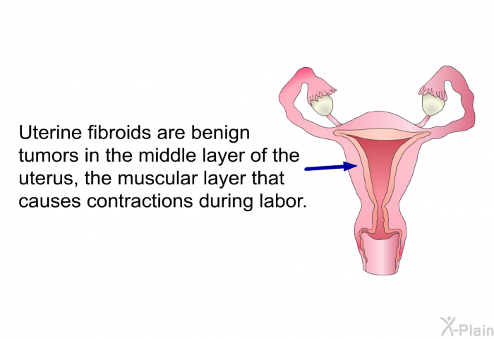 Uterine fibroids are benign tumors in the middle layer of the uterus, the muscular layer that causes contractions during labor.
