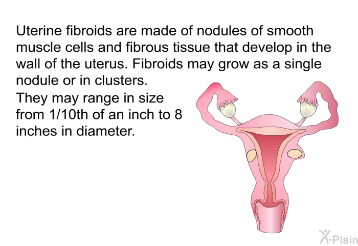 Uterine fibroids are made of nodules of smooth muscle cells and fibrous tissue that develop in the wall of the uterus. Fibroids may grow as a single nodule or in clusters. They may range in size from 1/10th of an inch to 8 inches in diameter.